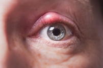 Eye inflammation or Blepharitis Treatment