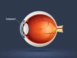 Diagram of human eye cataract