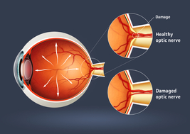 Glaucoma eye diagram